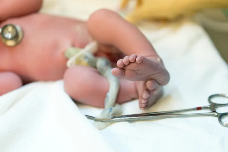 Photo of a new born baby where the focus is on feet and toes. The umbilical cord is there with surgical scissors attached. The face of the baby is not in the photograph. Body color is pink and feet are slightly purple.