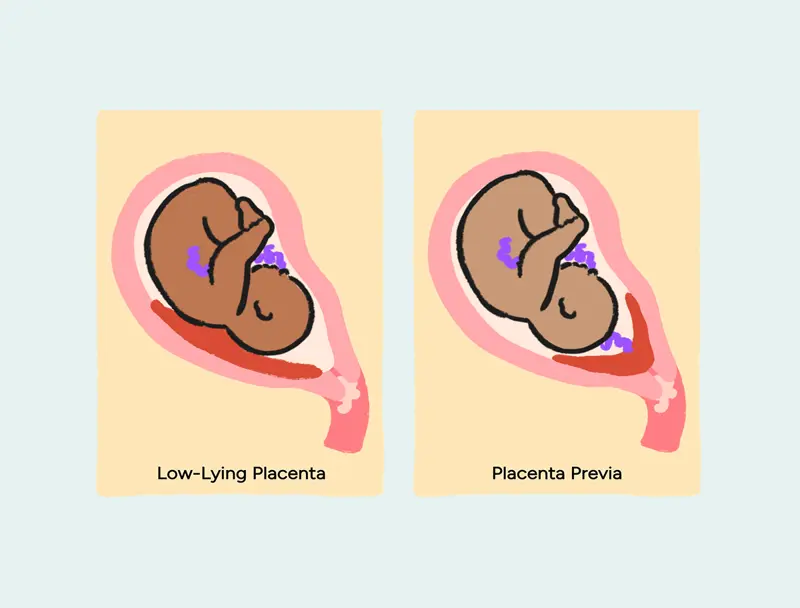 Placenta-Previa-Low-lying